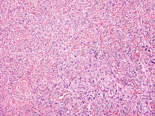 Fig. 10.27, Atypical fibrous histiocytoma showing interface between classic benign fibrous histiocytoma (upper left) and more atypical areas (lower right) .