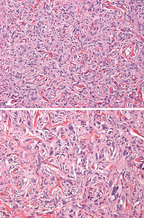 Fig. 10.28, Atypical fibrous histiocytoma showing areas of classic benign fibrous histiocytoma ( A ) and more atypical areas ( B ). Same case as Figure 10.27 .