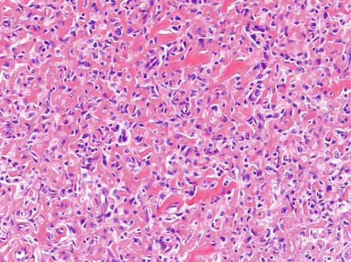 Fig. 10.30, Lipidized fibrous histiocytoma.