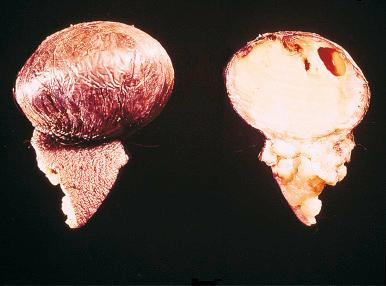 Fig. 10.3, Gross appearance of pedunculated cutaneous fibrous histiocytoma. The light color of the lesion results from large amounts of lipid. Focal cyst formation is also present.