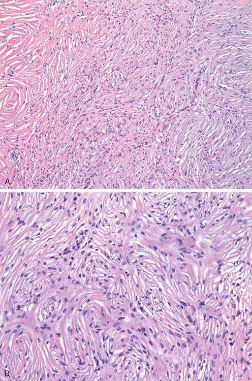 Fig. 10.33, A and B , Storiform collagenoma (sclerotic fibroma) a hypocellular lesion consisting of collagen fibrils arranged in storiform pattern and separated by cleftlike spaces. These lesions can resemble both fibrous histiocytoma and hyalinized area in dermatofibrosarcoma protuberans (DFSP).