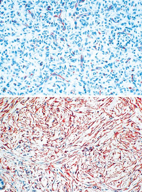 Fig. 10.34, CD34 immunostains of benign fibrous histiocytoma and DFSP. A, CD34 immunostain of fibrous histiocytoma decorates normal vessels. B, CD34 immunostain of DFSP, with majority of tumor cells decorated.