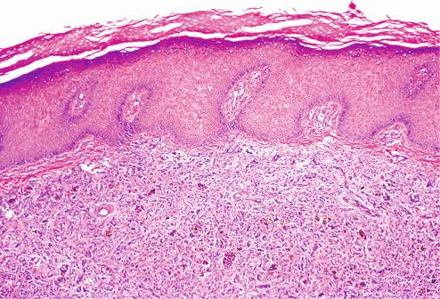 Fig. 10.6, Epithelial hyperplasia overlying fibrous histiocytoma.