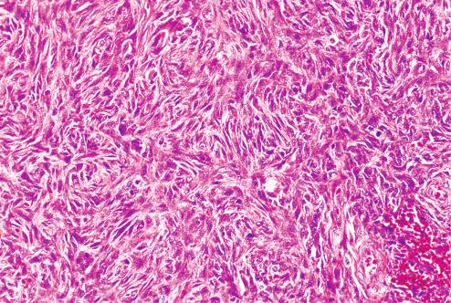 Fig. 10.9, Fibrous histiocytoma with predominantly spindled appearance.