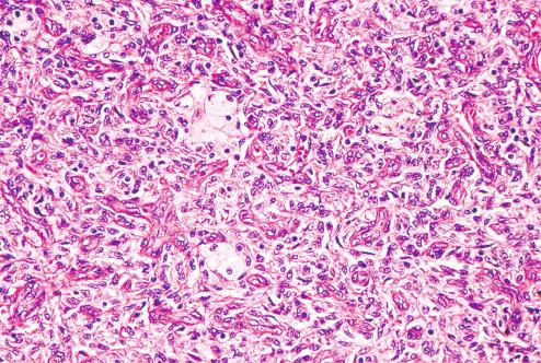 Fig. 10.10, Fibrous histiocytoma with mixture of spindled and xanthomatous cells.