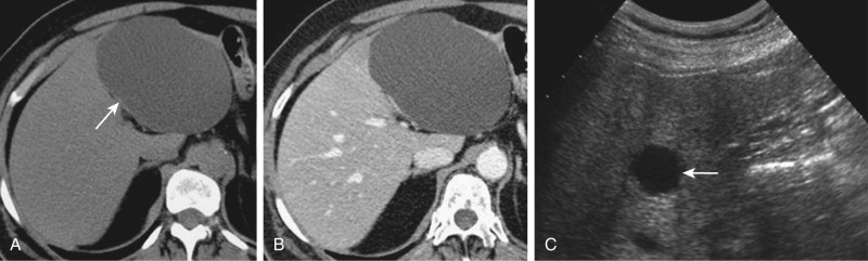 Figure 36-1, Typical presentation of hepatic (bile duct) simple cyst. A, Transverse precontrast computed tomography (CT) image shows a large, sharply defined lesion (arrow) in the left lobe of the liver that is hypoattenuating compared with the surrounding hepatic parenchyma and aorta. Hypoattenuation to the aorta on precontrast images is the single most important finding to diagnose cystic lesions on CT. B, Corresponding contrast-enhanced CT scan during portal venous phase demonstrates absence of lesion enhancement. C, Ultrasound image in a different patient shows a round, well-circumscribed mass (arrow) with imperceptible wall and increased through-transmission of sound waves.