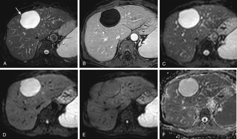 Figure 36-2, Typical presentation of hepatic (bile duct) simple cyst. A, Fat-suppressed T2-weighted fast spin echo magnetic resonance (MR) image shows markedly high intensity of the cyst (arrow). B, Gadolinium-enhanced T1-weighted gradient recalled echo MR image during portal venous phase demonstrates absence of lesion enhancement. C to E, On diffusion weighted images at b = 0 sec/mm 2 (C), b = 150 sec/mm 2 (D), and b = 800 sec/mm 2 (E) the cyst shows intensity decrease with increasing b-value. F, On corresponding apparent diffusion coefficient map the cyst shows strong hyperintensity.