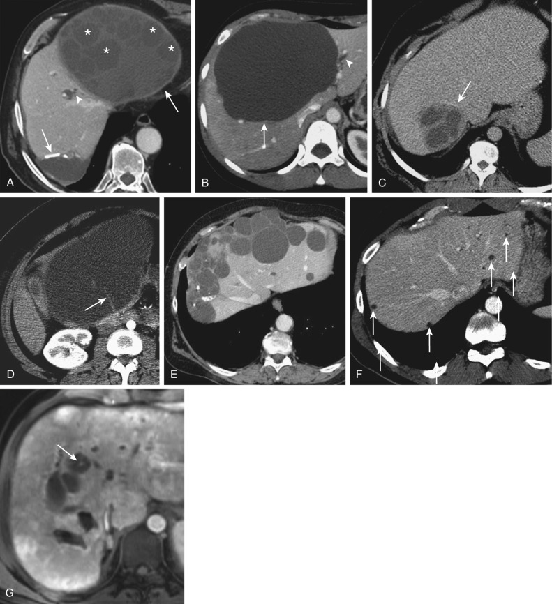 Figure 36-3, Imaging findings and differential diagnosis among different cystic lesions of the liver, including hydatid cyst, simple cyst, pyogenic abscess, biliary cystadenoma, polycystic liver disease, biliary hamartomas, and Caroli's disease. A to F, Portal venous phase computed tomography. G, Gadolinium-enhanced T1-weighted gradient recalled echo magnetic resonance image. A, Calcified wall (black arrow), thick enhancing wall (arrow), and daughter cysts (asterisks) are typical of hydatid cyst. B, A simple hepatic cyst has no visible wall (arrow). Note the mild intrahepatic biliary dilatation (arrowhead) secondary to mass effect in both cases. Other findings that may help in narrowing differential diagnosis when facing cystic liver lesions are ( C and D ) thick enhancing walls ( arrow, C ) and internal septa ( arrow, D ) in pyogenic liver abscess and biliary cystadenoma, (E) multiplicity and partially calcified walls in polycystic liver disease, (F) small size (<15 mm) and multiplicity (arrows) in biliary hamartomas, and (G) demonstration of a “dot sign” (arrow) resulting from a centrolesional portal venous branch in Caroli's disease.