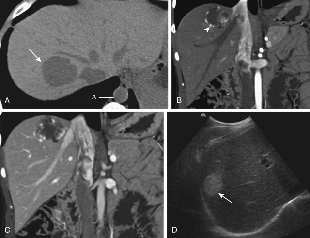 Figure 36-4, Typical cavernous hemangioma. A, Transverse precontrast computed tomographic image shows a 4-cm, hypoattenuating lesion (arrow) in the right lobe of the liver. Note the equal attenuation of the lesion with both aorta (A) and intrahepatic vessels. B and C, Coronally reformatted images of the same patient demonstrate nodular, peripheral, discontinuous enhancement ( arrowhead, B ) on both (B) hepatic arterial phase and (C) portal venous phase, which is comparable to vessels on all vascular phases. D, Ultrasound image in a different patient shows a homogeneous, well-defined, hyperechoic lesion (arrow) of the right hepatic lobe.