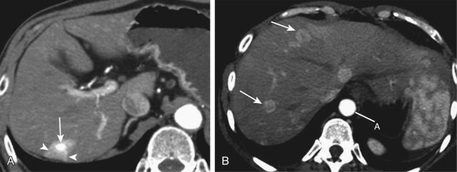 Figure 36-5, Imaging findings and differential diagnosis between capillary hemangioma and hypervascular metastases from breast carcinoma on transverse contrast-enhanced computed tomography during hepatic arterial phase. A, Capillary hemangioma (arrow) manifests as an isoattenuating lesion compared with the aorta, surrounded by a wedge-shaped, homogeneous, moderately hyperattenuating area (arrowheads) secondary to arteriovenous shunt. B, Hypervascular metastases (arrows) are multiple and demonstrate more heterogeneous enhancement, which is not as strong as that of the aorta (A). Enhancement characteristics along with a history of primary tumor allow the correct diagnosis.