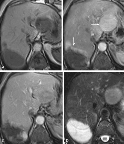 Figure 36-6, Imaging findings and differential diagnosis on magnetic resonance imaging (MRI) between cavernous hemangioma and hypervascular sarcoma metastasis coexisting in the same liver. A, Although both lesions are hypointense to surrounding liver parenchyma on T1-weighted gradient recalled echo MRI, metastasis ( horizontal arrow, B ) shows moderate hypervascularity and rapid washout on gadolinium-enhanced T1-weighted gradient recalled echo MR image during the hepatic arterial phase (B) and portal venous phase (C), respectively. B and C, In the same imaging phases, cavernous hemangioma ( vertical arrow, B ) typically shows nodular, peripheral, discontinuous enhancement, which progresses centripetally. D, Fat-suppressed T2-weighted fast spin echo MR image shows strong hyperintensity of hemangioma with only moderate hyperintensity of metastasis.