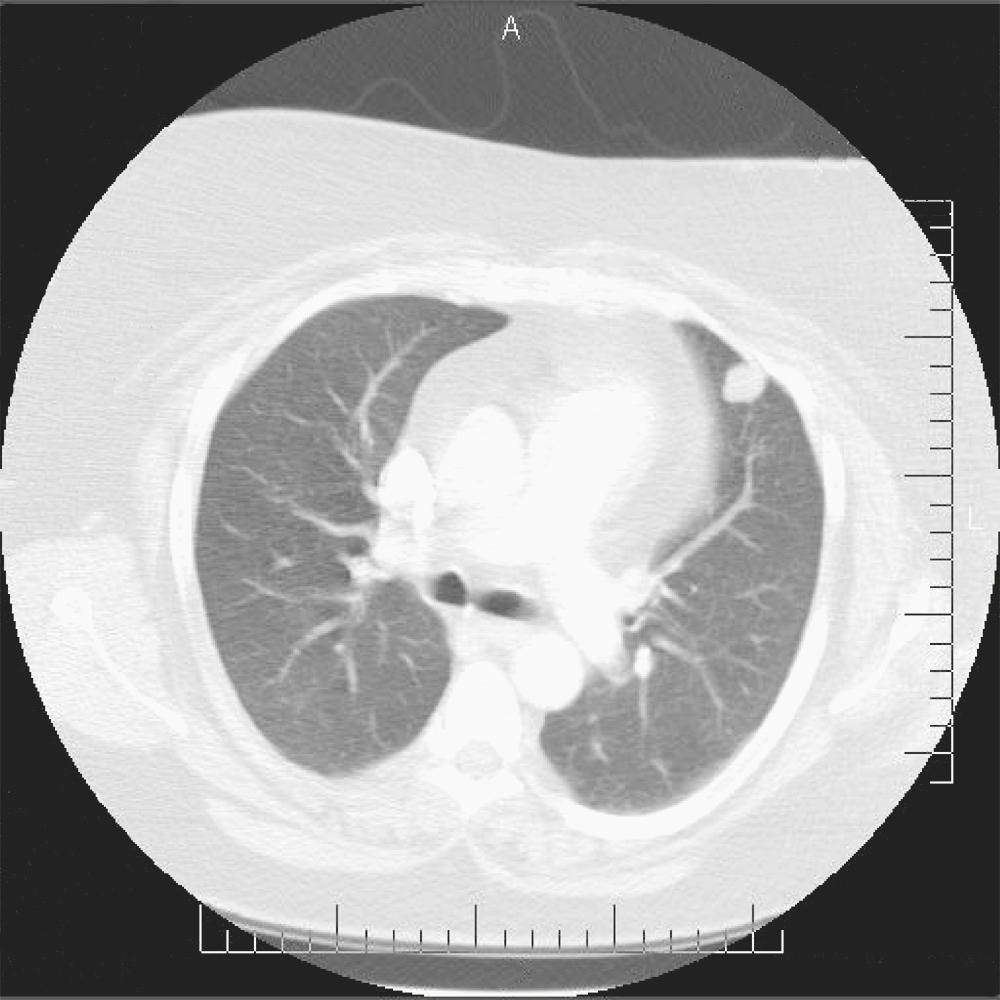 FIGURE 10-1, CT scan of the chest showing a chondroid hamartoma measuring 1.4 × 1.7 cm in the inferior lingula of the left lung. The patient was a 49-year-old woman with a normal PET scan. Because her clinical presentation was suggestive of malignant disease, a left upper lobe wedge resection was performed. Ninety percent of hamartomas are located in the periphery, and they account for about 4% of all solitary lung nodules.