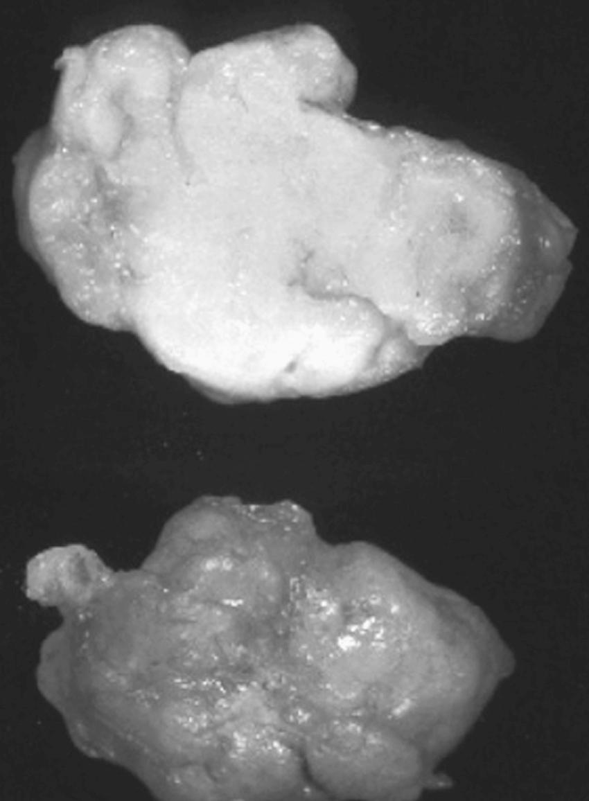 FIGURE 10-2, Cut surface of a resected hamartoma.