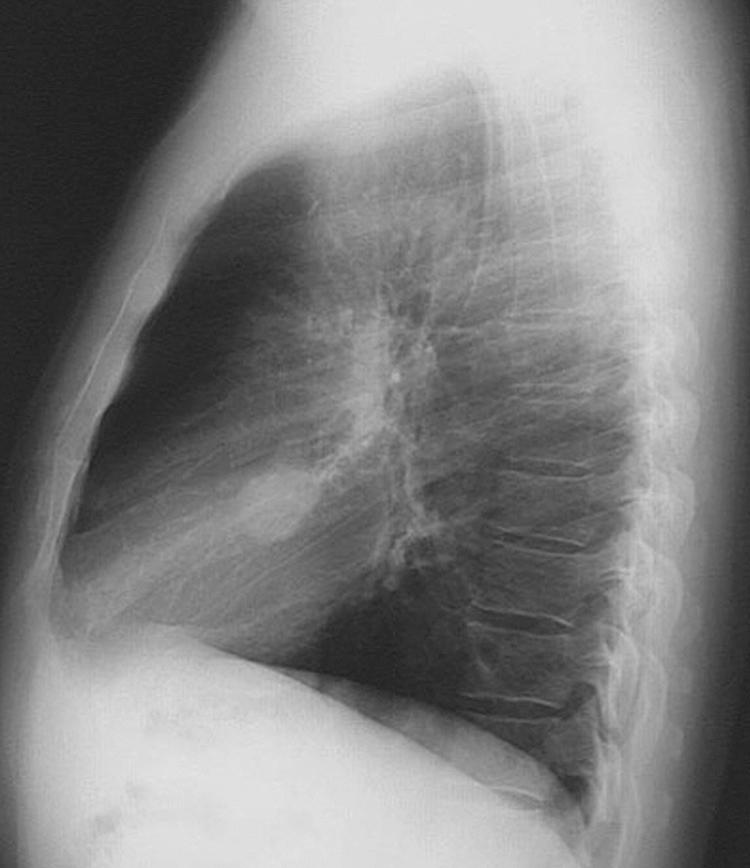 FIGURE 10-3, Lateral chest radiograph showing a round lesion consistent with a hamartoma.