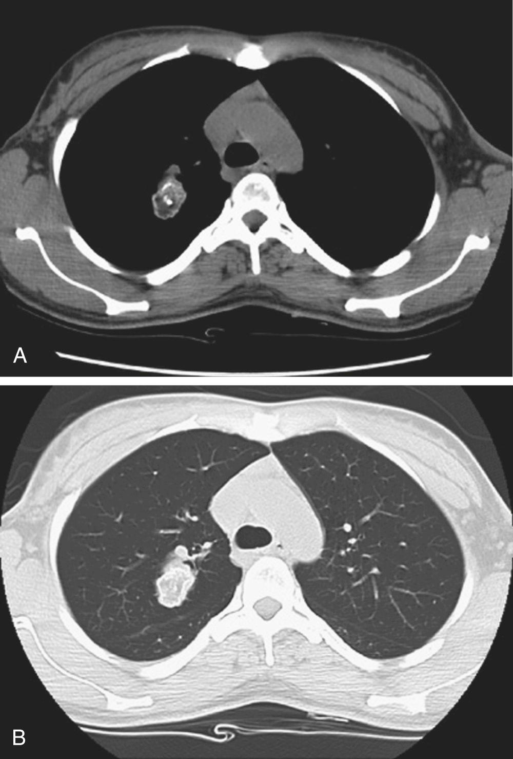 FIGURE 10-4, A, Right lung hamartoma. The lesion was resected, and a benign process was confirmed. Lesions are most often located in the lower lung fields and are well circumscribed. B, The majority are less than 4 cm in diameter, and calcifications can be appreciated on radiographs in 10% to 30% of cases.