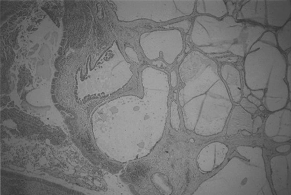 FIGURE 10-5, Photomicrograph of a mucous gland adenoma.