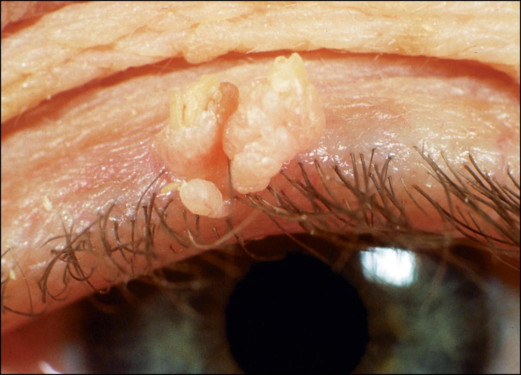 Fig. 27.1, Acrochordon (skin tag) of the upper eyelid.