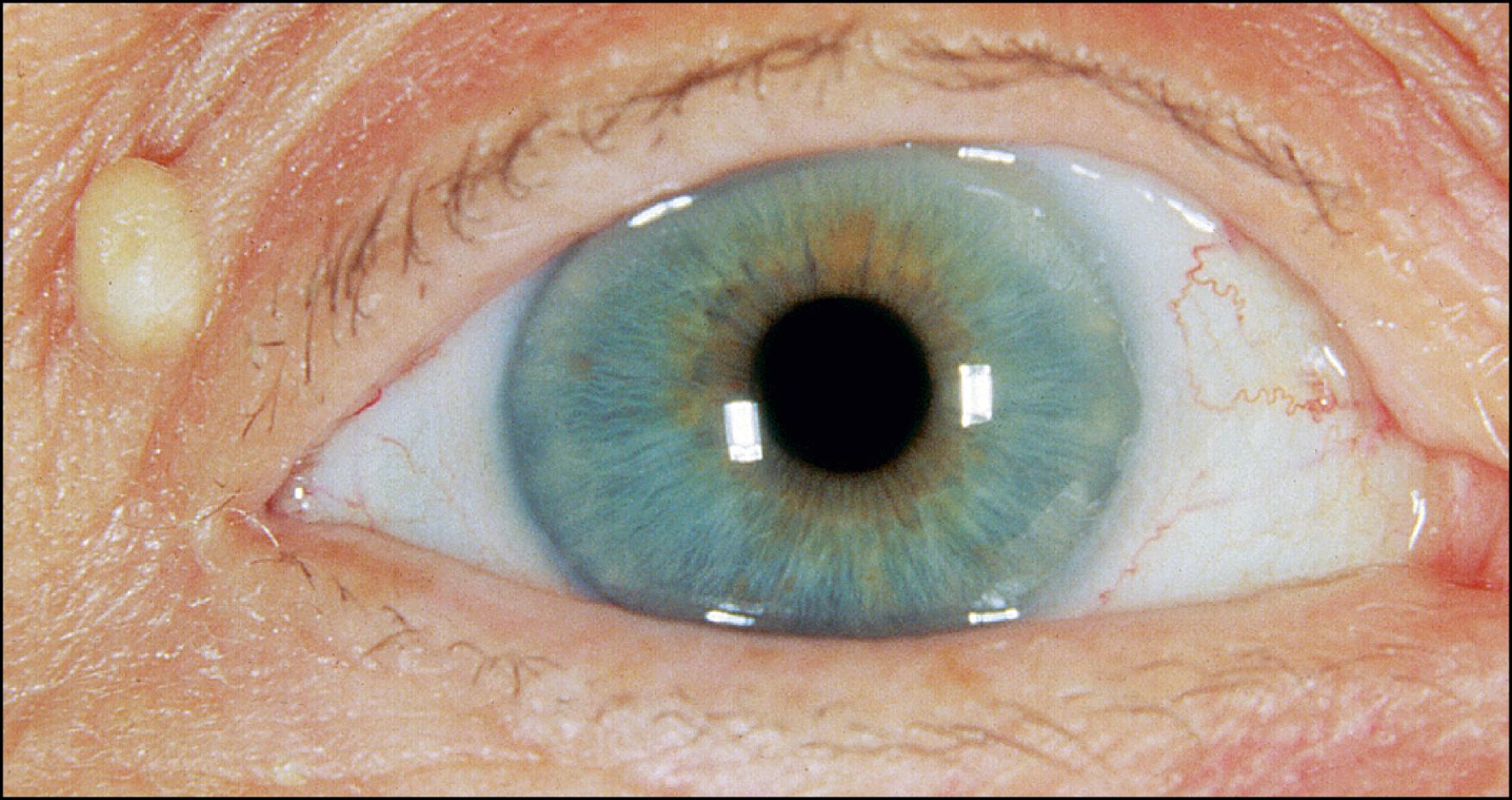 Fig. 27.2, Epidermal inclusion cyst of the right upper eyelid.