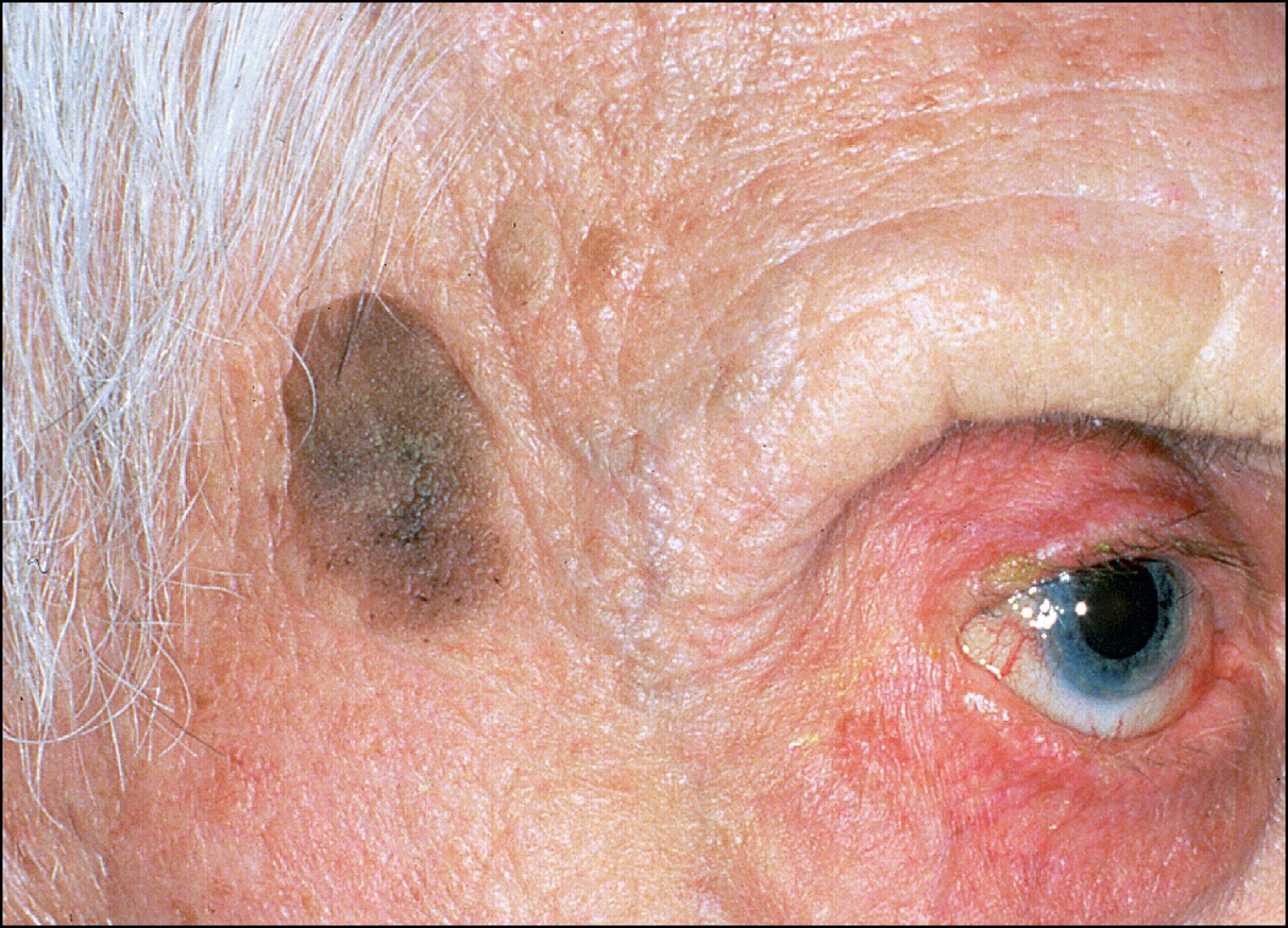 Fig. 27.3, Seborrheic keratosis of the temporal region of an elderly patient.