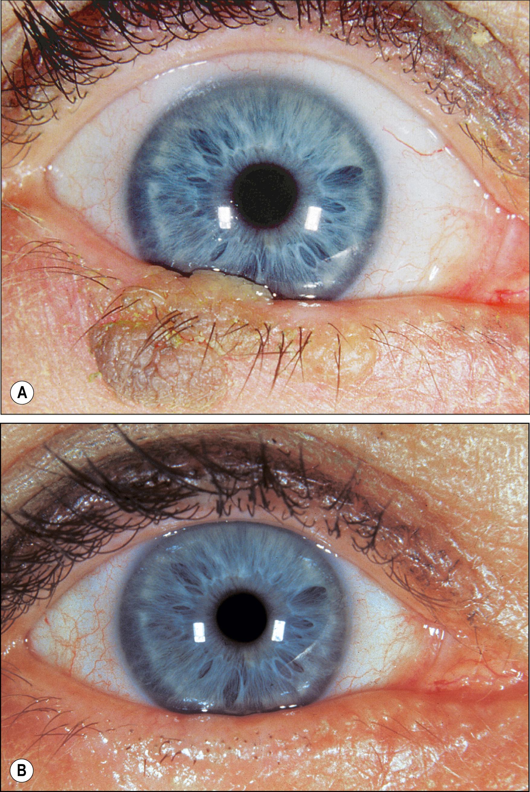 Fig. 27.4, Seborrheic keratosis of the lower eyelid. ( A ) The lesion displays a papillomatous configuration with friable cerebriform excrescences. ( B ) The same patient following surgical excision of the lesion.