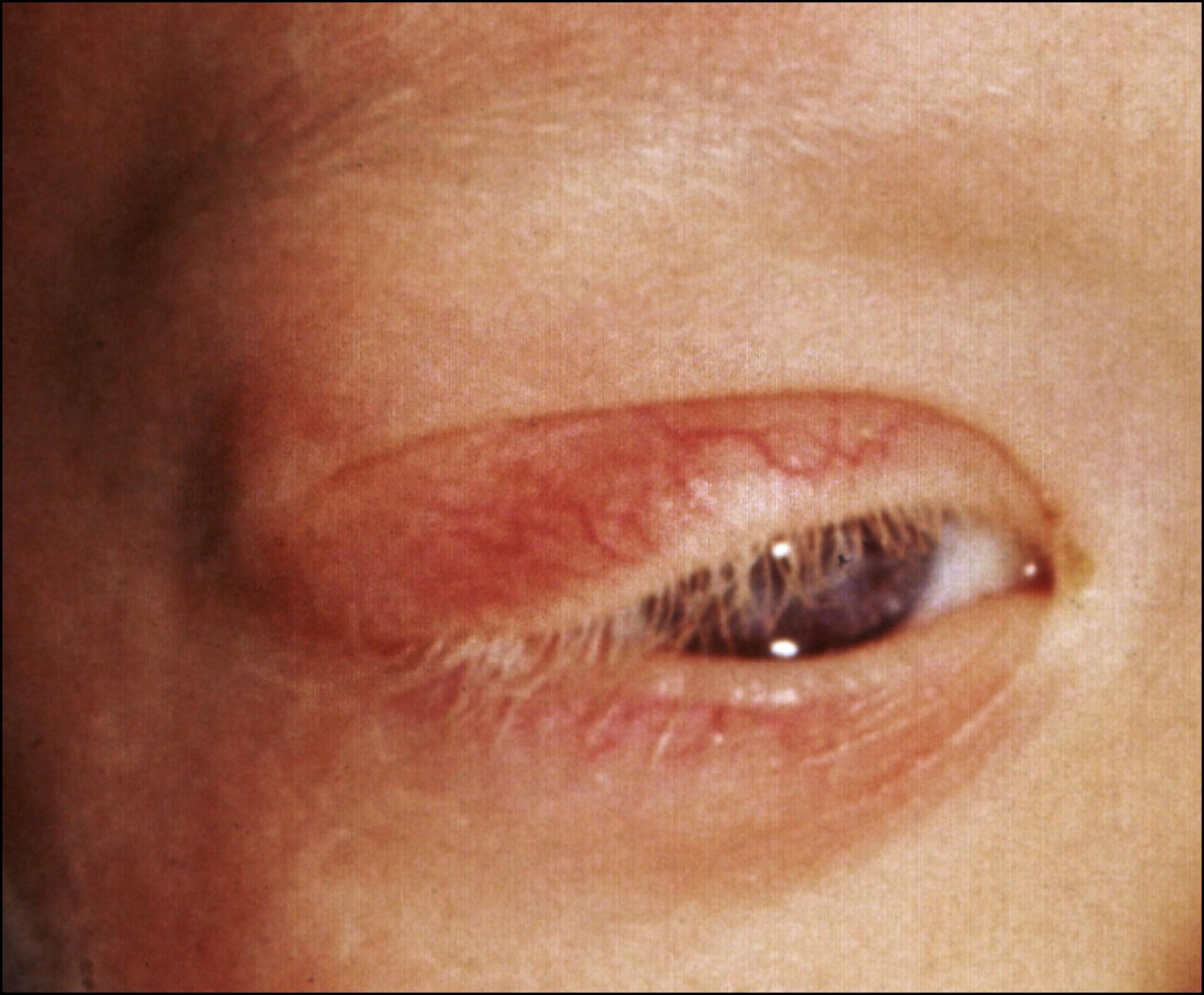 Fig. 27.9, Neurofibroma (plexiform neurofibroma) of the upper eyelid. Note the characteristic S-shaped configuration of the eyelid created by the tumor.