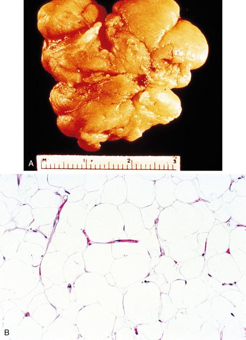 Fig. 13.1, A, Lipoma showing distinct multilobular pattern and uniform yellow color. B, Lipoma consisting of mature fat cells throughout has only slight variation in cellular size and shape.