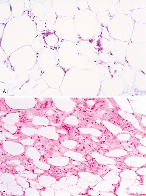 Fig. 13.3, A, Lipoma with focal fat necrosis with rare macrophage nuclei and vacuolated cytoplasm between mature fat cells. B, Lipoma with more extensive area of fat necrosis. Numerous macrophage nuclei with granular cytoplasm are seen between mature adipocytes. C, Rare example of fat necrosis in newborn infant. Note needlelike appearance of necrotic fat.
