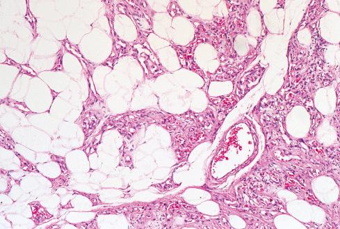 Fig. 13.5, Angiolipoma consisting of a mixture of fat cells and narrow vascular channels. The vascularity is more prominent in the subcapsular areas.