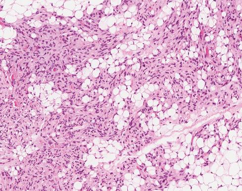 Fig. 13.6, Angiolipoma with small vessels with an infiltrative-like appearance between mature fat cells.