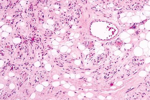 Fig. 13.7, Angiolipoma with fibrin thrombi, a characteristic feature of this tumor.