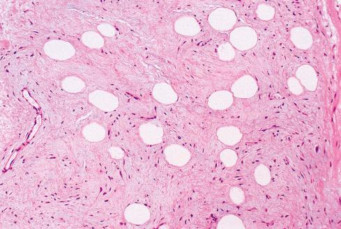Fig. 13.9, Myolipoma with a mixture of elongated eosinophilic smooth muscle cells and adipocytes.