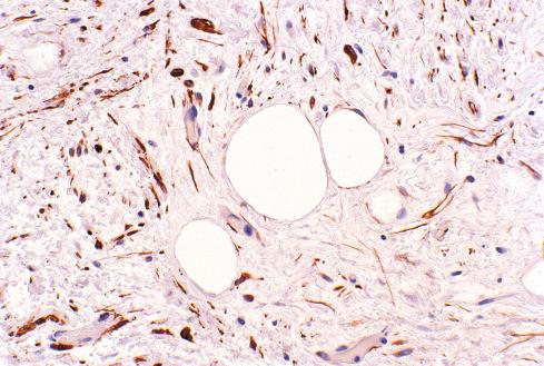 Fig. 13.10, Myolipoma stained for desmin, showing that virtually all the spindle cells are smooth muscle cells.