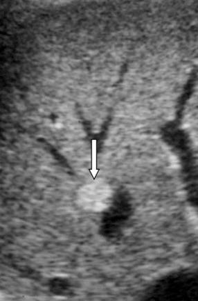 Fig. 49-1, Hemangioma, ultrasonography. The lesion shows typical features and appears as a round, well-defined, hyperechoic nodule ( arrow ).