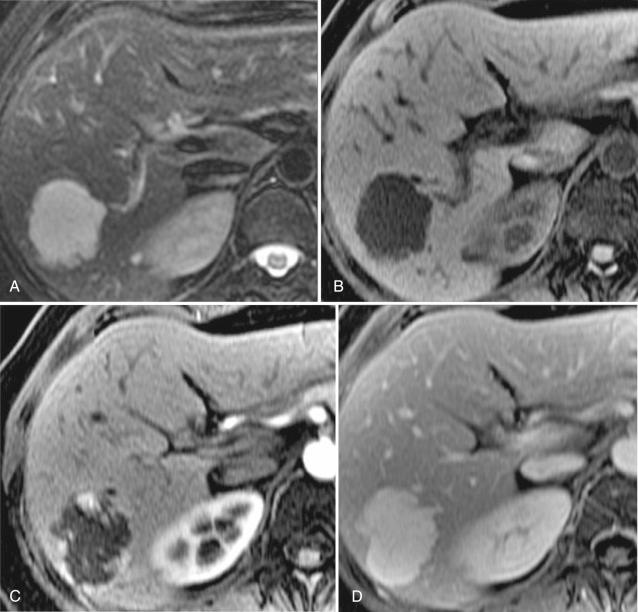 Fig. 49-2, Hemangioma, magnetic resonance imaging (MRI).