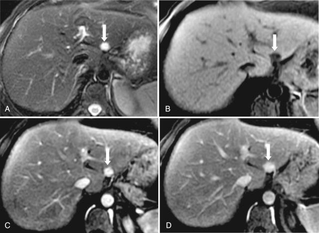 Fig. 49-3, Hemangioma, magnetic resonance imaging (MRI).