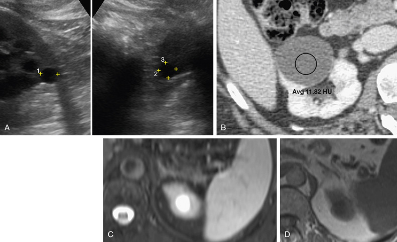 Figure 63-1, Three simple renal cysts are shown on ultrasonography (A), unenhanced computed tomography (B), and T2-weighted (C) and T1-weighted (D) magnetic resonance imaging.