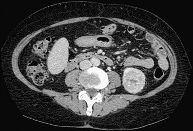 Figure 63-11, Contrast enhanced computed tomography shows a well-defined left renal mass with a hypodense scar, found on biopsy to be renal cell carcinoma.