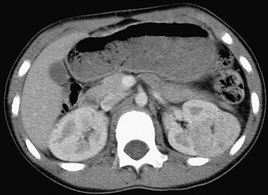 Figure 63-2, The solid lesion in the left kidney contains a small focus of fat centrally that represents an angiomyolipoma.