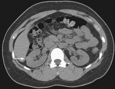 Figure 63-3, The lesion in the right kidney (arrow) is slightly hyperdense to renal parenchyma and at biopsy was proved to be a lipid-poor angiomyolipoma.