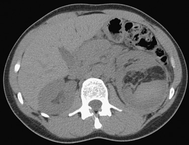 Figure 63-4, Angiomyolipoma is evident in the posterior left kidney. Note associated hemorrhage.