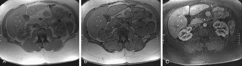 Figure 63-5, Angiomyolipoma. A, T1-weighted magnetic resonance image shows a hyperintense lesion arising from the posterior left kidney. B, Out-of-phase image shows an India ink artifact around the lesion. C, Fat-suppressed image demonstrates loss of signal intensity in the lesion.