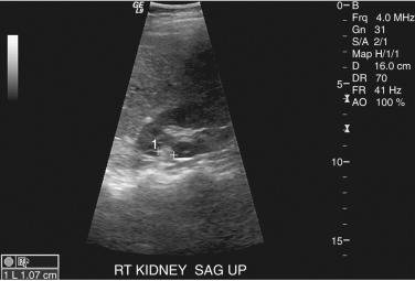 Figure 63-6, Angiomyolipoma. Ultrasound image shows a round echogenic structure in the upper pole of the kidney. RT, Right; SAG, sagittal.