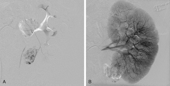 Figure 63-7, Exophytic hypervascular mass in the lower pole with multiple abnormal vessels containing microaneurysms.