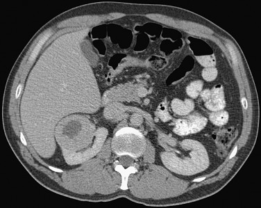 Figure 63-8, Postcontrast axial computed tomography shows a solid enhancing lesion in the upper right kidney with central hypodense scar.