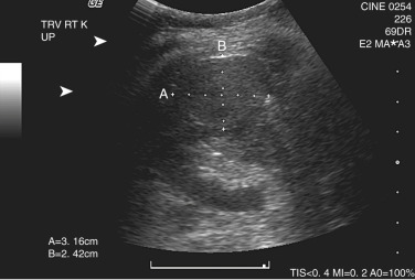 Figure 63-10, Ultrasound image shows a well-defined solid isoechoic mass. K, Kidney; RT, right; TRV, transverse.