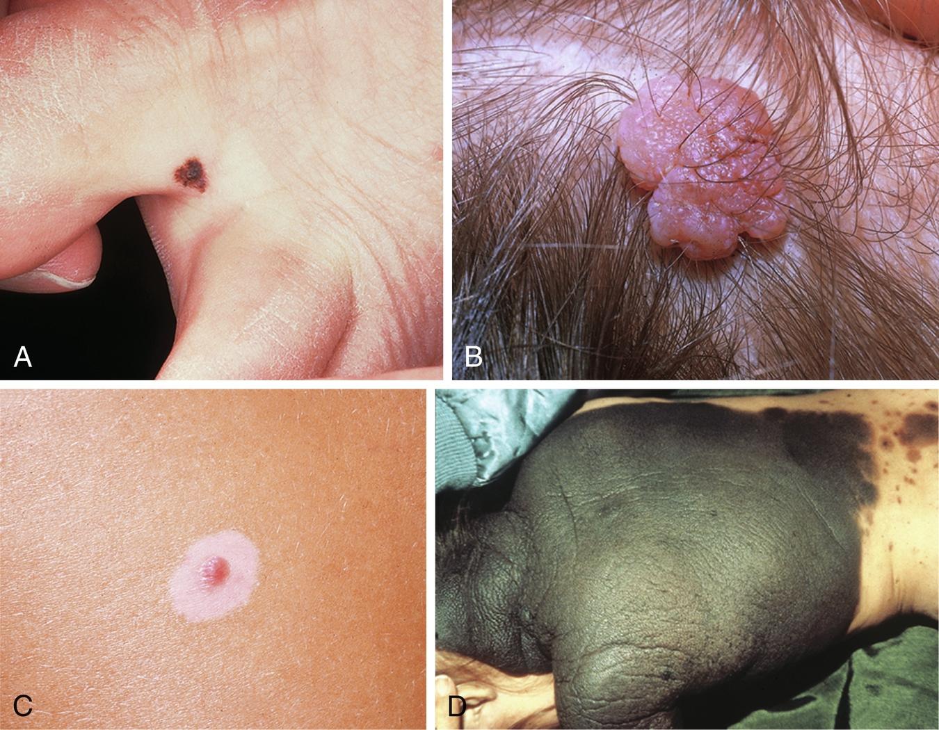 Fig. 40.1, A, Junctional nevi are typically small, flat, and dark brown in color. B, An intradermal nevus also may be very exophytic or papillomatous, as shown here. C, Typical halo nevus of the back demonstrating a central brownish-red papule. D, Large congenital nevus with multiple smaller congenital nevi. These lesions present a surgical challenge and a significant cosmetic problem.