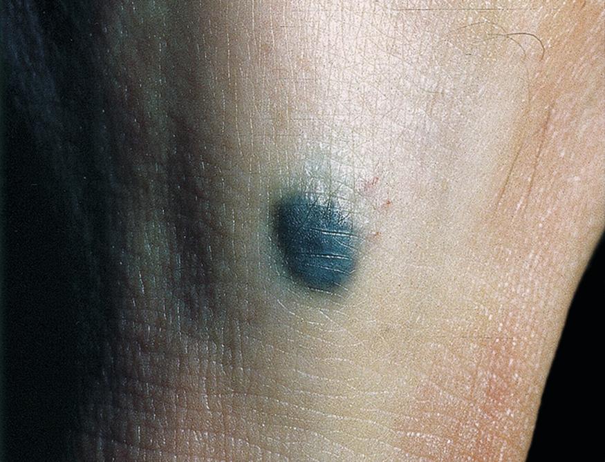 Fig. 40.2, Blue nevus on the lower leg.