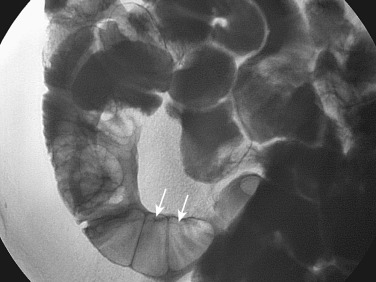 Figure 27-1, Linear ulceration (arrows) along the mesenteric border of a segment of ileum. These ulcers usually run parallel to the mesenteric border and can exceed 15 cm in length.