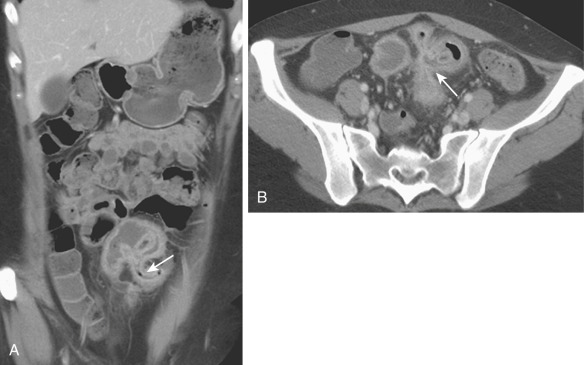 Figure 27-11, Ileosigmoid fistula. Coronal (A) and axial (B) computed tomography enterography images demonstrate the fistulous communication (arrows) between the inflamed ileum and sigmoid colon segments. Exact localization of these fistulas is important for surgical planning.