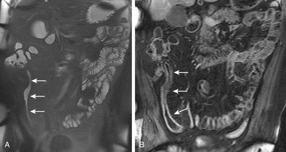 Figure 27-12, Magnetic resonance (MR) enterography. Coronal fat-saturated T2-weighted.W single-shot fast spin echo (A) and contrast-enhanced T1-weighted (B) MR images show the asymmetric stricture involving a long segment of the terminal ileum (arrows). Note the increased fat around the terminal ileum.